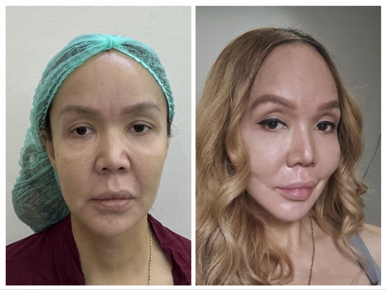Treatment Result 7